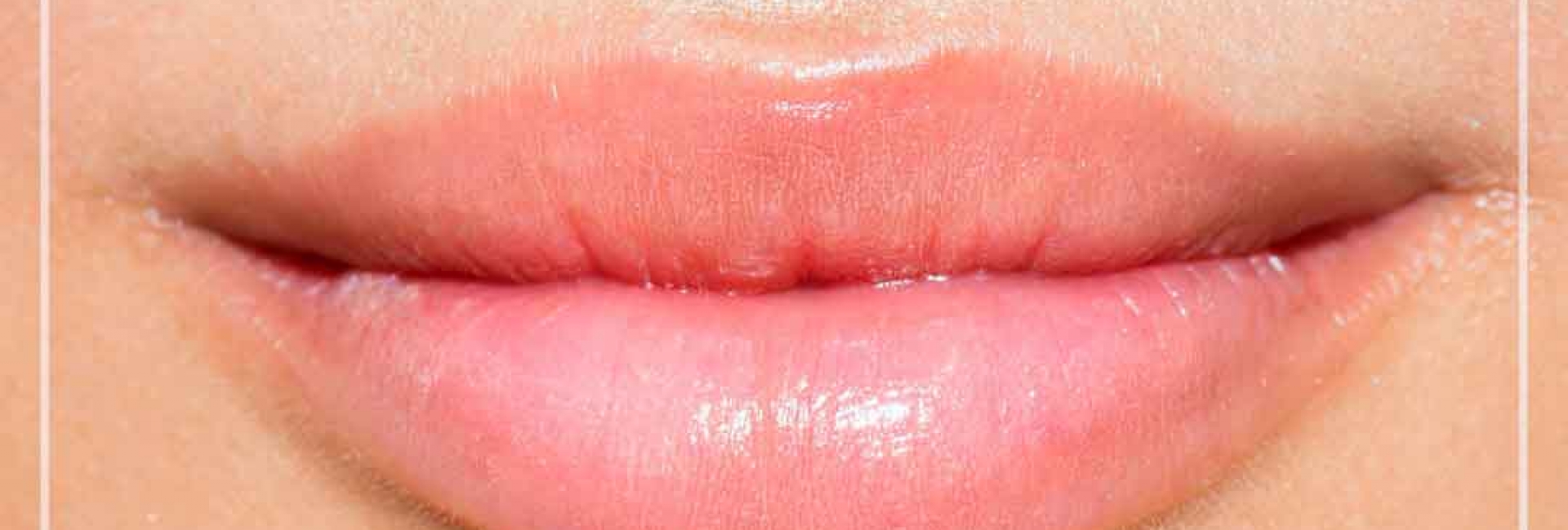 Увеличение губ филлерами